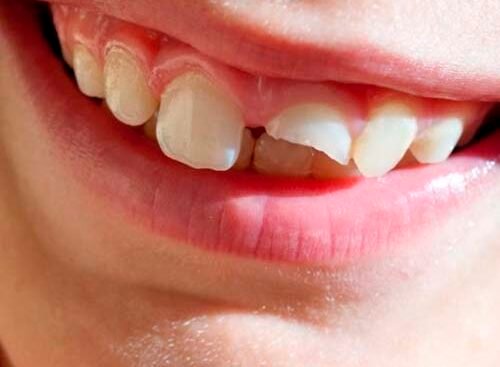 Qué significa soñar con dientes rotos